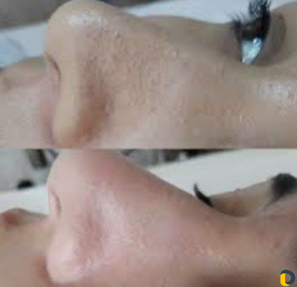Ультразвуковая чистка лица