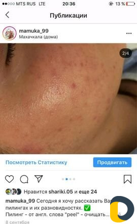 Узи чистка лица
