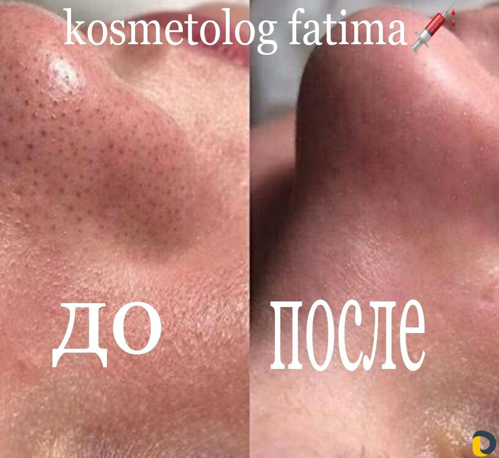 Узи чистки лица