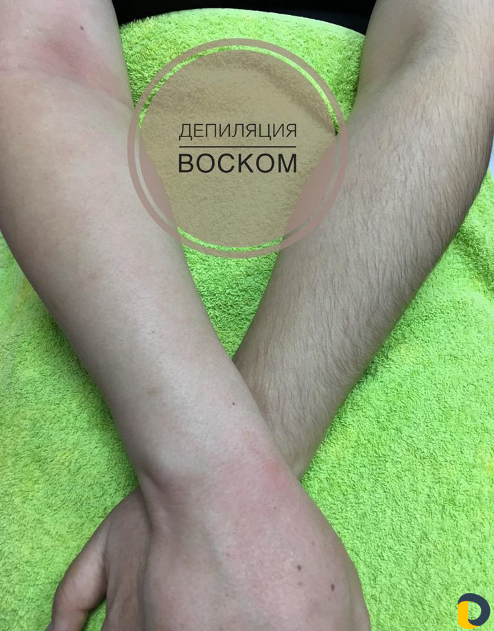 Восковая депиляция, эпиляция воском