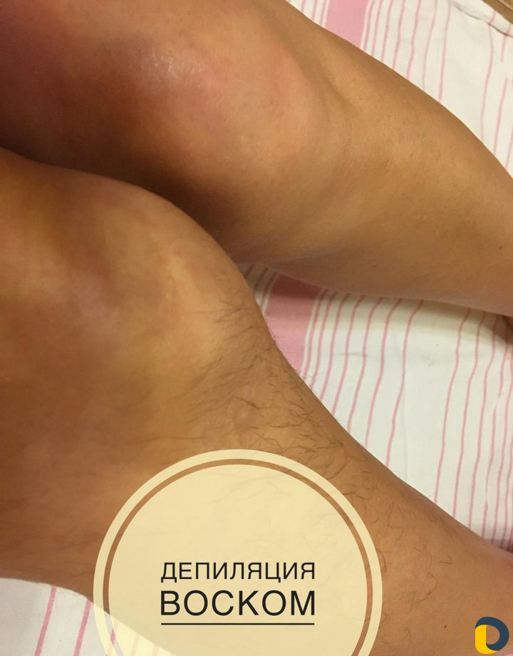 Восковая депиляция, эпиляция воском